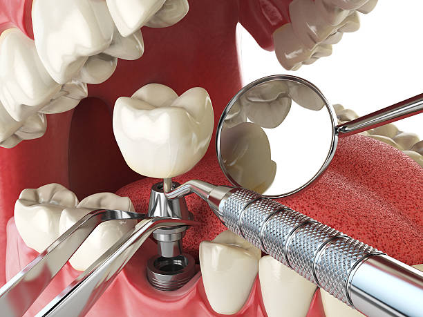 Best Root Canal Emergency Dentist  in Valenti, NE